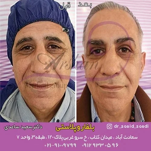 نحوه ی درمان افتادگی پلک با بلفاروپلاستی به چه صورت است؟