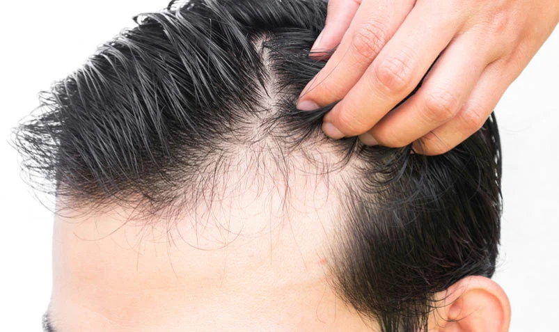 پیوند مو؛ آخرین راه حل برای ریزش مو؟