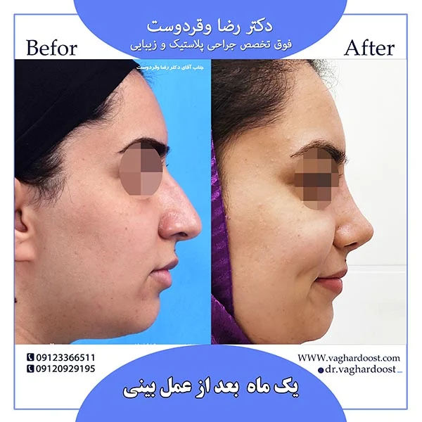 بهترین متخصص رینوپلاستی را چگونه پیدا کنیم؟