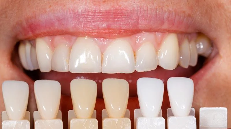 لمینت دندان عوامل موثر در انتخاب رنگ لمینت دندان