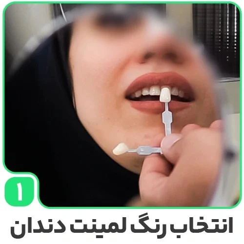 لمینت دندان عوامل موثر در انتخاب رنگ لمینت دندان