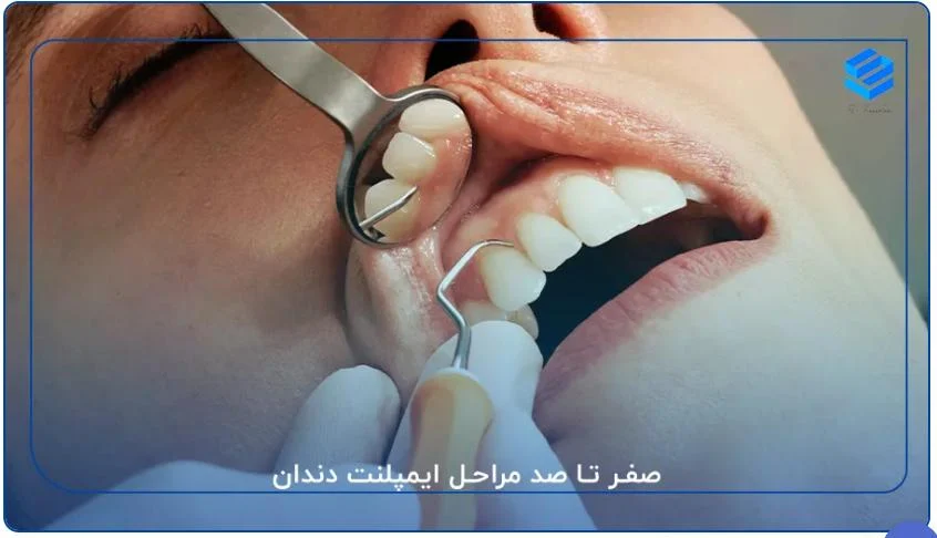 مراحل کاشت دندان و عمر مفید آن برای داشتن لبخندی زیبا و ماندگار با ایمپلنت دیجیتال