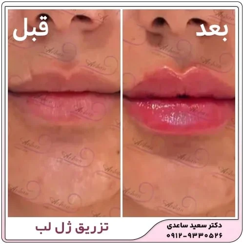 راه های از بین بردن ورم لب بعد از تزریق ژل